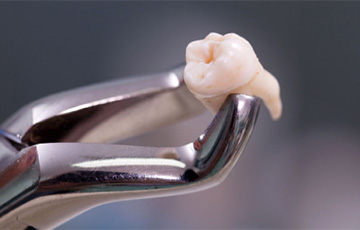 В Стамбуле мужчине удалили четыре передних зуба в стоматологии