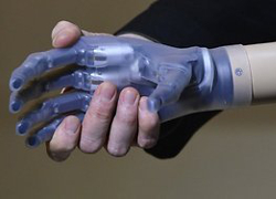 Литовцу первому в мире установили бионный протез руки